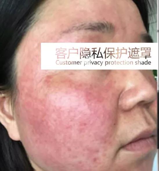 糖皮质激素依赖性皮炎(glucocorticoids dermatitis)是指因长期外用